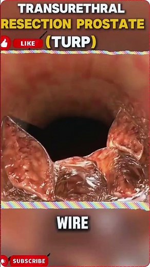 3D animation of Transurethral Resection of the Prostate (TURP) #TURP#Healthcare
