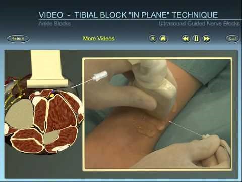 Ankle block: tibial nerve ultrasound guided block "in plane" technique