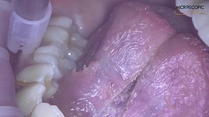 2.7K views | Lingual frenectomy with Nd Yag laser under microscope | Microscopic Dental Club Page | Facebook