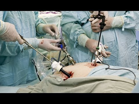 Laparoscopic Cholecystectomy