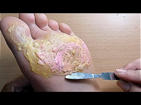 Peeling - Remove damaged skin on legs! Video you can watch without thinking HQBT002