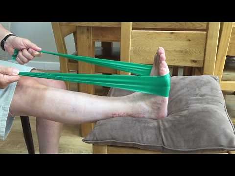 My trimalleolar fracture, ORIF surgery and recovery, as it happens Pt 2