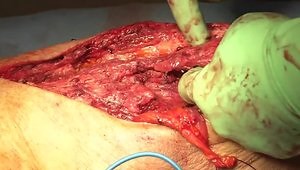 Reconstruction of Extensor Mechanism Defect with Sartorius Muscle Transfer