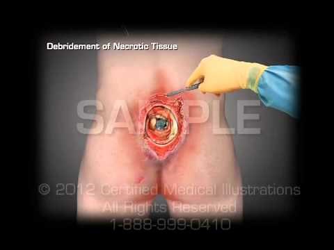 Surgery of Sacral Pressure Ulcer