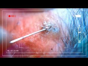 blackheads - Removal from deep inside skin