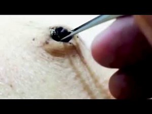 the biggest blackhead popped
