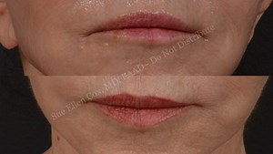 Clinical Application of Neuromodulators: Lower Face/Neck - Rejuvenation Resource