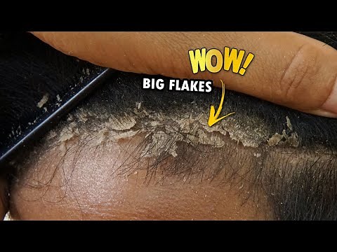 Removing Psoriasis Flaky Scalp Satisfying #373
