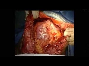 Abdominal wall reconstruction with the posterior component separation TAR