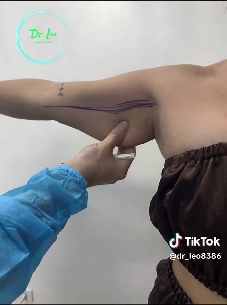 Liposuction Sale: 50% Off in the Philippines