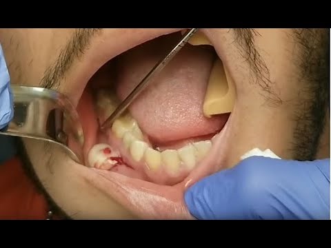 Explosive Tooth Pus!