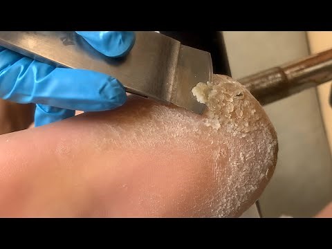 Callus removal from feet&Foot scraping dead skin【Xiao Yan pedicure】#stress 1112