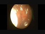 Eustachian Tube Dysfunction Resulting From Chronic Nasal Conditions • Video • MEDtube.net