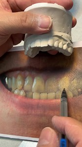 5-Unit Treatment Plan Wax-Up! Case from Dr. Colleen Chambers in Massachusetts! | LSK121 Oral Prosthetics