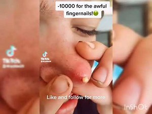 The cyst Bomb || huge blackheads removal and Pimples popping SPR #32