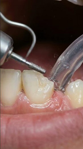 Dentist Fixes a Broken Tooth in Minutes! Satisfying Tooth Repair