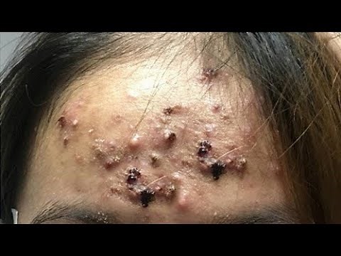 Big Cystic Acne Blackheads Extraction Blackheads & Milia, Whiteheads Removal Pimple Popping