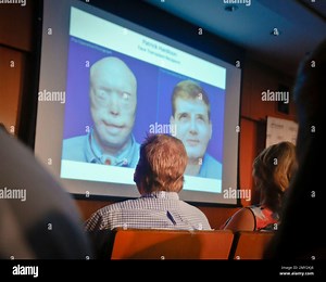 Former Mississippi firefighter Patrick Hardison, 42, center, views a video showing progression of his face transplant, during a press conference marking one year after his surgery, Wednesday Aug. 24, 2016, at New York University Langone Medical Center in New York. Hardison was disfigured while trying to save people from a house fire in 2001 and received the face of a Brooklyn cyclist who died in an accident in July 2015-- a surgery successfully perform by a team of doctors at NYU Langone. (AP Ph