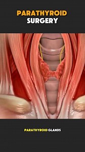 46K views · 473 reactions | #parathyroid #surgery #surgeon #doctor #gland #bonehealth #hormones #weakness #abnormal #calcium #medical3danimation #3dmedicalanimation | Medcare777 | Facebook
