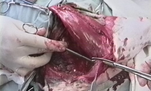 Canine Forelimb Amputation: Video for Veterinarians