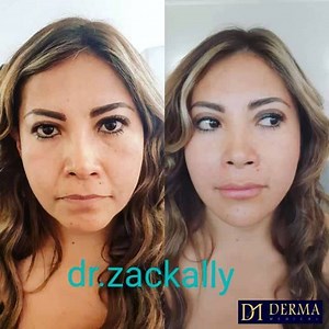 ☝️PERIORAL SCULPTING (fresh-off-the-needle) ▪▪▪▪▪▪▪▪▪▪▪▪▪▪▪▪▪ Before and 10 minutes after perioral sculpting to create a naturally structural and rejuvenating change to the lower face using medium-to-high-density dermal fillers. 4ml used ~~~~~~~~~~~~~~~~~~~~~~~~ 💉Immediate results, no surgey, no downtime ~~~~~~~~~~~~~~~~~~~~~~~~~~~ 👉TRAINING: 🇬🇧 UK: www.dermamedical.co.uk 🇸🇪SWEDEN: www.dermamedical.se 🇦🇪 DUBAI: www.dermamedical.ae 🇦🇺 AUSTRALIA: www.dermamedical.net.au ~~~~~~~~~~~~~~~~~