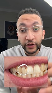 54K views · 624 reactions | ⁨ الـ RESIN BONDED BRIDGE⁩ | Omar Abu Ghebasha | Facebook