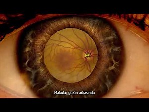 Sarı nokta hastalığı nedir? Kimlerde görülür?