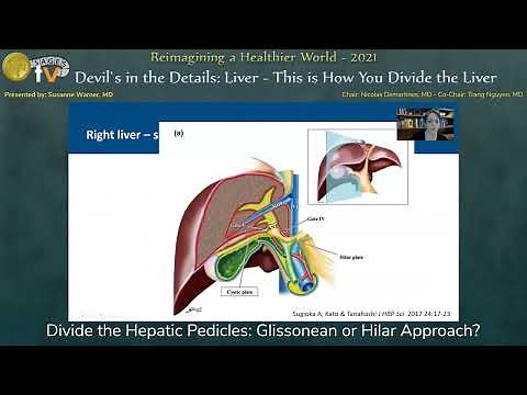 Divide the Hepatic Pedicles: Glissonean or Hilar Approach?