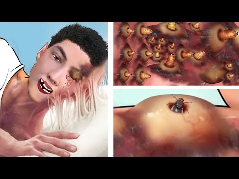 ASMR Removes large pustule larvae nests & Treating maggots on the face | Deep Cleaning Animation