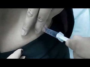 how to do an intramuscular injection in the buttock. intramuscular injection