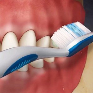 Modified Bass Technique is the tooth brushing technique that you...