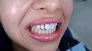 Before After Teeth Whitening Comparison Young Stock Footage Video (100% Royalty-free) 3936787595 | Shutterstock