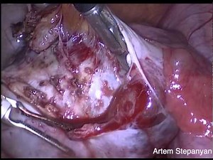 Laparoscopic Dermoid Cyst Removal
