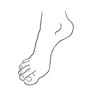 Tips For Treating Extensor Tendinitis - Lance Silverman, MD - Orthopedic Foot & Ankle Surgeon