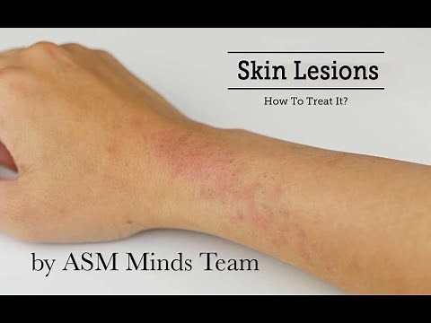 Skin lesions part 1(Benign and Premalignant) by ASM Minds Team