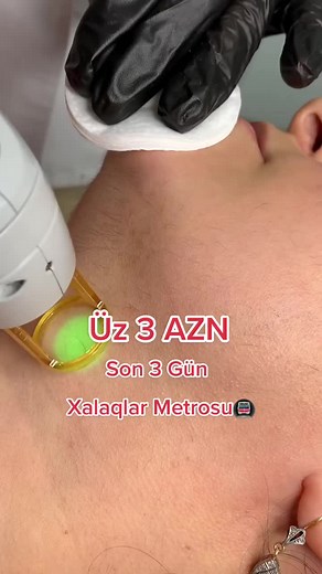 Tüklərin tam tökülməsinə zəmanət veririk. Yazılmağa tələsin. ENDİRİMLƏRİMİZDƏN xəbərdar olmaq üçün səyfəmizi izləməyi unutmayın. __________________ 📍Ünvan : Xalqlar dostluğu (Bəhruz Nuriyev 32) 📲 Əlaqə üçün: 070-375-45-03 #azerbaijan #baku #instagram #laser #xanim #müşterimemnuniyeti #beautiful #beauty #micro #müşterimemnuniyeti #xanimlar #baximlixanimlar #instagram #microblading