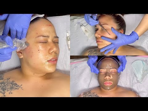 MICRONEEDLING FACIAL WITH DERMAPLANE | MY FIRST MICRONEEDLING TREATMENT | PREPARATION AND AFTERCARE