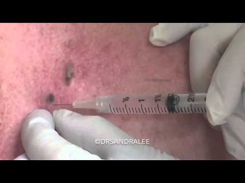 Removal of seborrheic keratoses with scissor excision. For medical education- NSFE.
