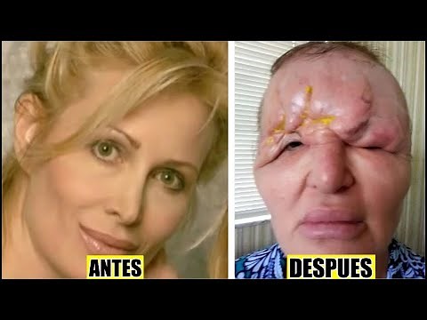 15 Peores Cirugías Plásticas Que Fracasaron