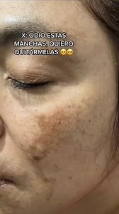 ¿Sueñas con una piel uniforme, radiante y sin imperfecciones? Permíteme presentarte nuestra crema despigmentante, una solución efectiva respaldada por resultados probados. Esta innovadora fórmula ha sido cuidadosamente desarrollada para ayudarte a desvanecer las manchas oscuras, hiperpigmentación y marcas de acné, brindándote una tez clara y luminosa. Volviendo al color natural de tu piel 😃✅️ | Beauty Concept