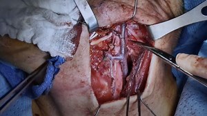 Prophylactic arterial ligation following TORS oropharyngeal cancer resection - Mayo Clinic