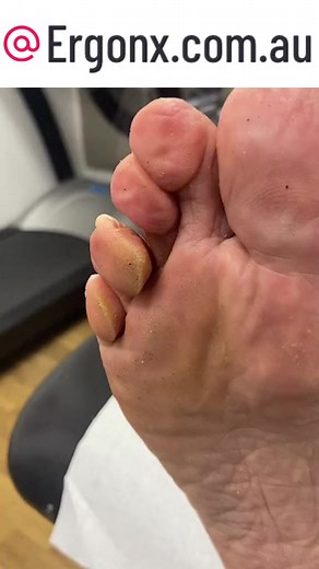 Pinch callus temoval from the toe of a patient by a podiatrist. Another name for a pinch callus is a tyloma #docpods #callus #corn #tyloma #pinchcallus #ergonx #podiatry #australia | Piesperfectosmx
