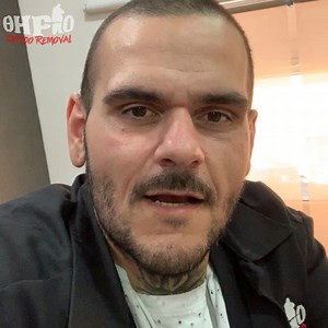 1.3K views · 49 reactions | Κάναμε πλήρη ανάπλαση σε ουλές με fractional cool beam laser και τα αποτελέσματα και ο πελάτης μιλάνε για εμάς!!! | Thirio Tattoo Removal | Facebook