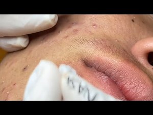 RELAXING WITH NASA SPA || SQUEEZE ACNE VIDEO #34