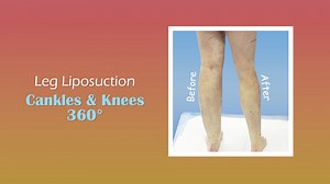 🔥 Immediate Liposuction Results 🔥 ULTRA-COMPLETE, HIGH-DEFINITION, AWAKE, SAFE #LIPOSUCTION of the #Ankles, #Calves aka #Cankles, and Knee Complex #Lipo360Knees performed by Liposuction and #Lipedema Specialist #DrThomasSu 💪🏼 Slimmer, Shapelier and Pain Free #Legs are Possible! 💥 See Your Results Immediately!! 💥 Minimal Downtime!! Call us today ☎️ 813-886-9090 or visit ➡️Artlipo.com to schedule a complimentary consultation! 📲 FREE Virtual Consultations!! 💥 Long Distance consultations are