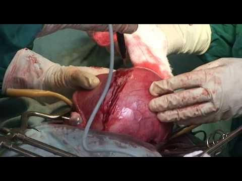 Myomectomy - uterine incision