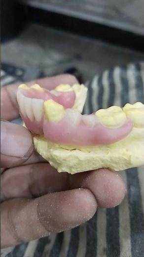 Lower Flexible Partial Denture Ready For Flasking 😁😁😁#rpddentalprocedure
