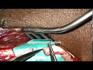 Sural nerve cable graft to ulnar nerve
