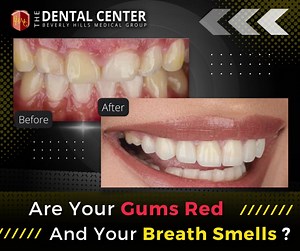 Are your gums receding? Increasing your risks for tooth decay and other oral health issues. Over time, this can contribute to loosening of the teeth and, in severe cases, tooth loss. An expertly crafted gum graft protects your teeth and their roots from further decay and prevents inflammation, ultimately preventing receding tissue. Get treated for gingivectomy today for as low as P4500. | Beverly Hills Medical