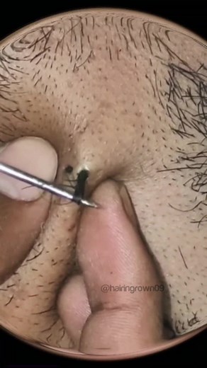 Satisfying Ingrown Hair Extraction | Facial & Pubic Hair Removal